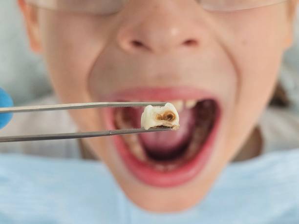 Best Emergency Gum Treatment in Hicksville, OH